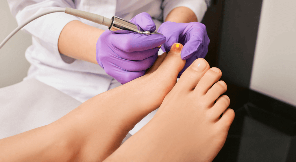Fungal Nails infection