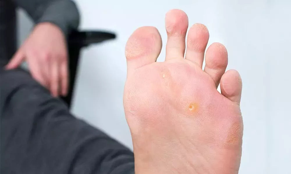 Corns & Planter Warts