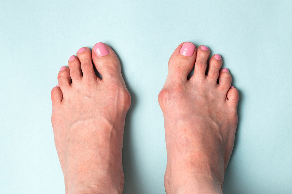 Bunion