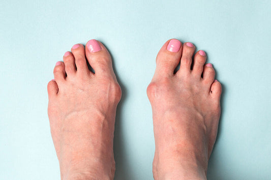 Bunion