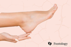 Complete Guide to Cracked Heels: Causes, Prevention, Treatment & More!