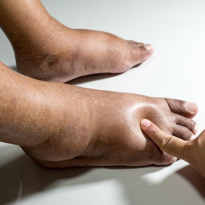 Diabetic Foot Cream