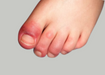 Ingrown toenails Treatment