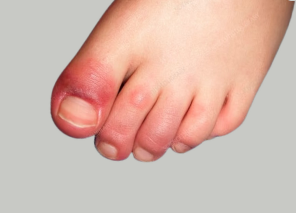 Ingrown toenails Treatment