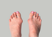 bunion surgery