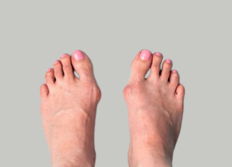 bunion surgery